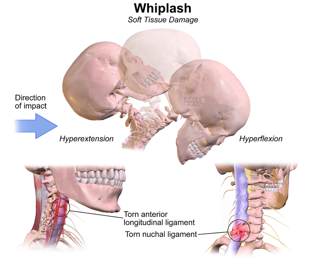 Chiropractic Treatments for Whiplash Due to a Car Accident by Southside Chiropractic & Car Injury Clinic